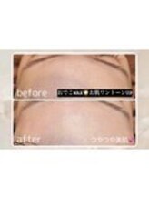 透明感UP！【おでこＷＡＸ】おでこの産毛と古い角質をとり生まれたてのツヤツヤおでこ◎