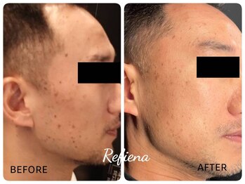 クリニカルエステ リフィーナ 西荻窪店/シミケア対策、今すぐ始めよう！