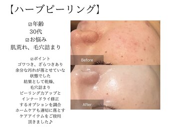 サロンツキ(salon tuki)/お客様症例/ハーブピーリング