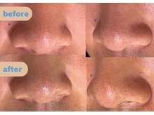 リスキン(Reskin)の雰囲気（アクアピール。皮脂のつまり、ザラつき、ごわつきに◎）