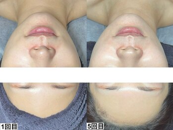 アンドミー 中百舌鳥(&me)/ララピール【艶肌/美白/くすみ】