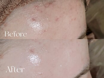 ウィハナ(wehana)/【ララピール】ニキビ/赤み