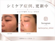 ラシェ プリズ 心斎橋/シミケア症例、更新中