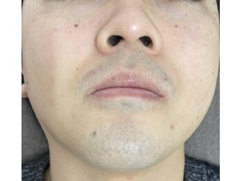 ナノハナ/鹿沼市全身脱毛のナノハナ