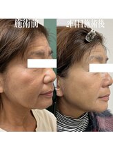 コリー(Kolly)/リフェイス"全顔"