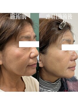 コリー(Kolly)/リフェイス"全顔"