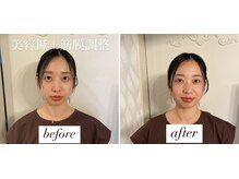 ヤマモト 表参道院(YAMAMOTO)/美容鍼＋筋膜調整
