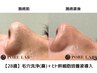 【OPEN記念!】いちご鼻解消！毛穴洗浄＋美容液導入(ヒト幹細胞培養液)￥4980