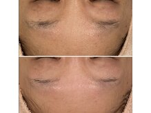 トータルエステティック ジョワイユ(JOYEUX)/★毛穴、くすみ、乾燥、肌改善★