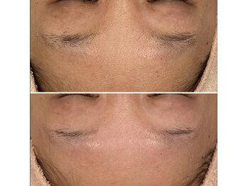 トータルエステティック ジョワイユ(JOYEUX)/★毛穴、くすみ、乾燥、肌改善★