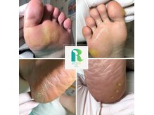 レイ(Ray)の雰囲気（たこ・魚の目…我慢できないストレスから解放されませんか？？）