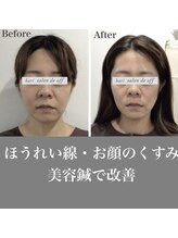 ハリサロンドオフ 心斎橋店(hari salon de off)/ほうれい線・くすみ改善