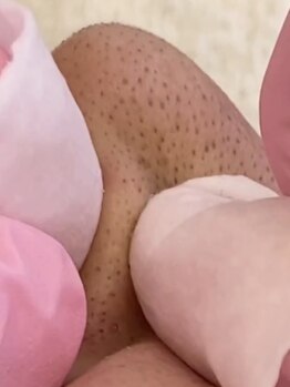ヒルナム(Heal Nam)の写真/毛穴の黒ずみ、ざらつき、詰まりなどをしっかり解消！お肌の専門家の技術で憧れのツルツルお肌に★