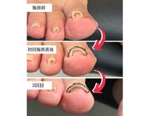 巻き爪矯正センター 沖縄 宜野湾の雰囲気（巻き爪矯正！爪に負担をかけずに徐々に広げていきます！）