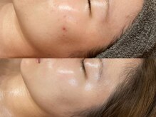 ビジュープラス 広島店(Bijou+)/【20代/ニキビケア、くすみ】