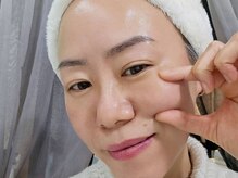 水光ピールスキン