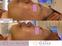 シエスタ(siesta)/-彩-ハーブピーリング