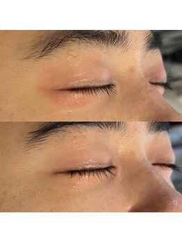 リリアス(RILLIAS)/1年間続いた目周りのかぶれ