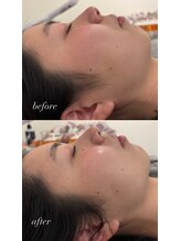 マホロバ(mahoroba)/最新美容鍼ダーマ鍼