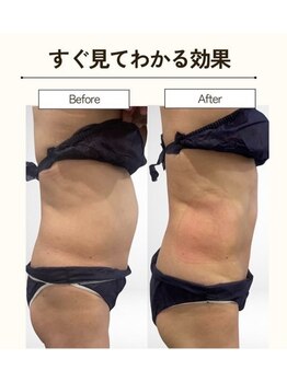 アスプリール/脂肪冷却変化