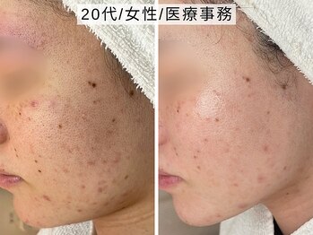 ハナコ 下通店(HANAKO)の写真/誰もが悩む、毛穴開きを改善！