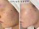 ハナコ 下通店(HANAKO)の写真/誰もが悩む、毛穴開きを改善！