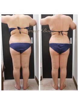 痩身脱毛専門店 グレイスボディ MEGAドンキホーテ三郷店(Gracebody)/◆痩身　症例写真