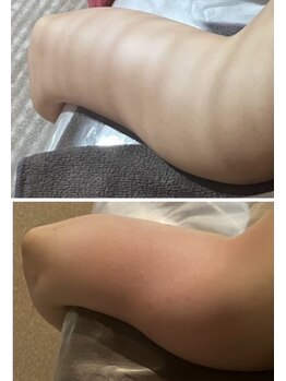 ミーラブ 鹿児島(miilove)/30代二の腕ほっそりケア