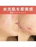 敏感肌・水光肌になれる再生トリートメント ¥8,800-