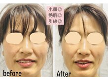 ヨサパーク シュエット(YOSA PARK CHOUETTE)/お顔引き締まって小顔に♪