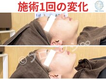 【一回り小顔に】究極小顔コースの施術について