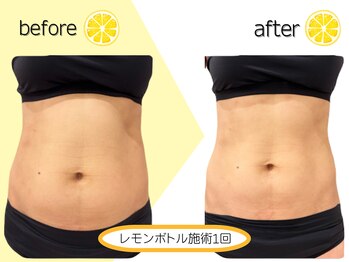 クリニカルエステ イーズ 小倉リバーウォーク北九州デコシティ店/レモンボトルBefore&After