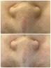【美容液25ml1本付★】毛穴本気改善!黒ずみ・開き毛穴ケア! BABYEXOパック