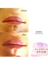 ココ センガ ビューティー クリニック(COCO SENGA Beauty-Clinic)/ジェットピール唇ヒアルロン酸