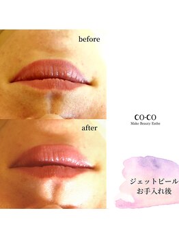 ココ センガ ビューティー クリニック(COCO SENGA Beauty-Clinic)/ジェットピール唇ヒアルロン酸