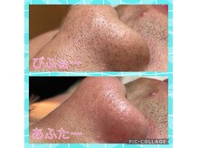 １回の施術で絶大な効果◎ClearSkinを目指しましょう♪