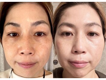 コモア(COMOA)/月1、1年でこの効果！