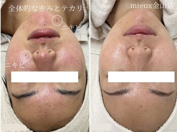 ミュー 金山店(mieux)/サロンケア×ホームケアで肌育