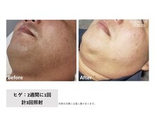 ケイナイン(K-NINE)/メンズ ヒゲ脱毛