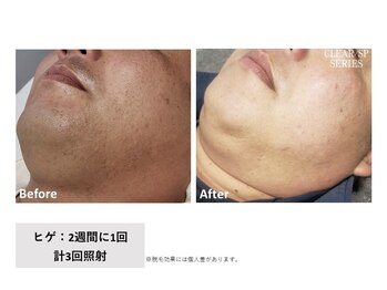 ケイナイン(K-NINE)/メンズ ヒゲ脱毛