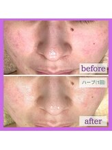 アヴァンス(AVANCE)/気になる赤みにハーブピーリング