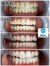 ブラン 心斎橋店(Blanc)/矯正中のゲスト様の施術例