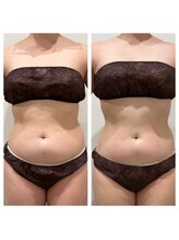 エステティックサロン ラ ベルタ(Esthetic Salon La Belta)/レモンボトルボディ