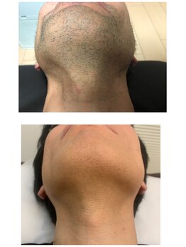 リッチアンビューティー(Rich.an beauty)/美肌ヒゲ脱毛