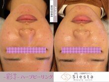 シエスタ(siesta)/-彩-ハーブピーリング