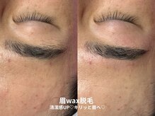 ピブ(pib.)/1~2週間剃毛不要！