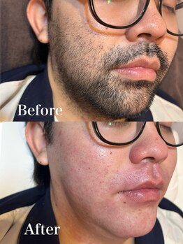 ジョエルワックス 沖縄那覇店(JOELLE WAX)/男性必見！髭お悩み改善！