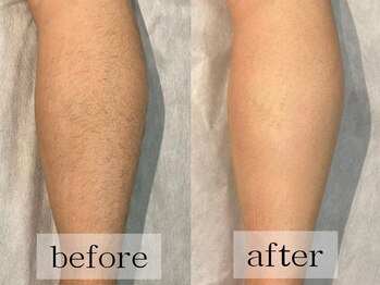 グランビューティ(Glanz Beauty)/20代男性