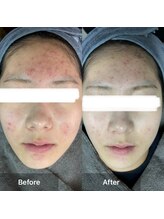 モカ 天王寺店(MOKA)/剥離ハーブピーリングニキビケア