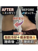 前田鍼灸接骨院/脂肪冷却＋痩身整体